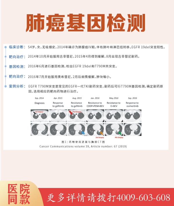 基因检测，了解双鸭山先天性青光眼遗传病风险